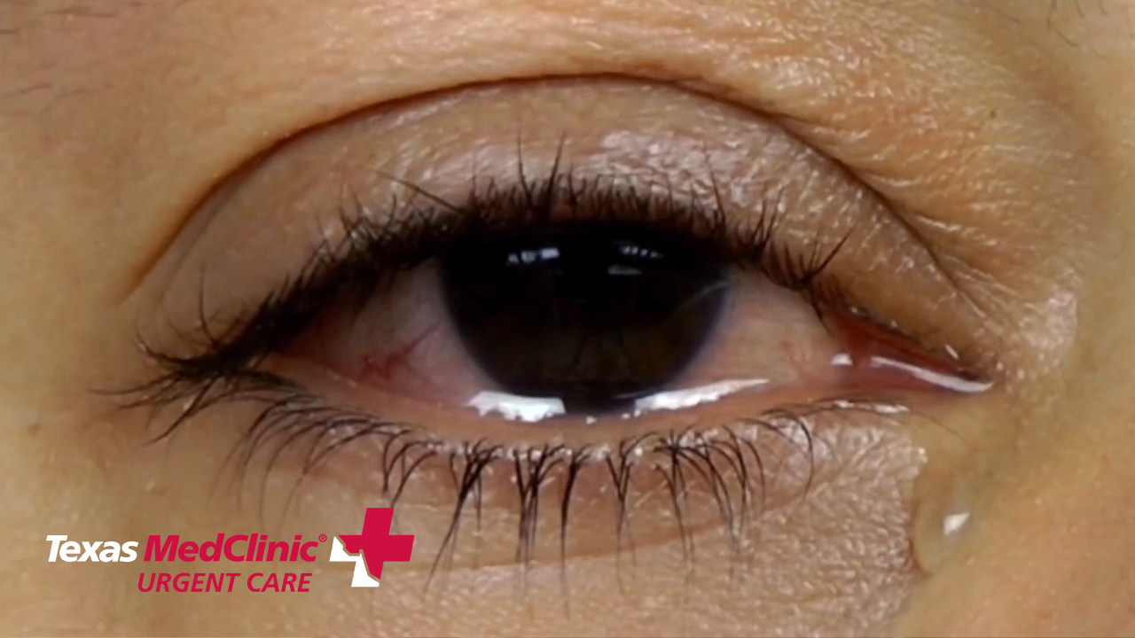 Pink Eye - Texas MedClinic Urgent Care